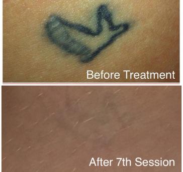 Laser Tattoo Removal at Rewind Laser Treatment | In Romford Essex
